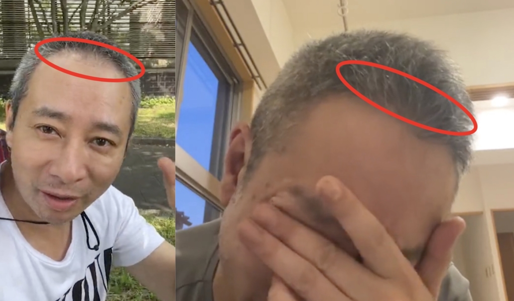 いしだ壱成の植毛は失敗?