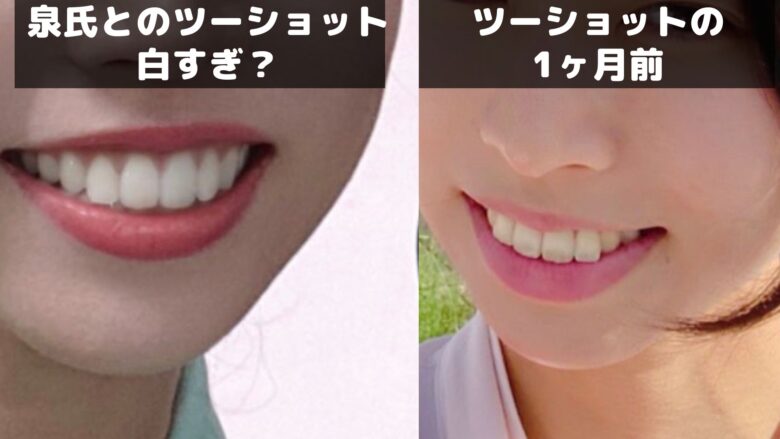 今井るる2022年4月の歯(左)と今井るる2021年9月の歯(右)の白さ比較